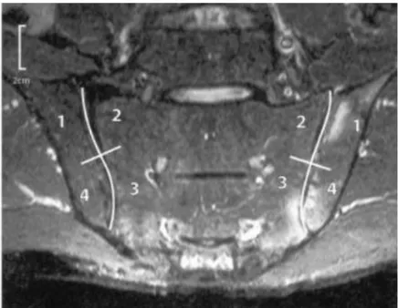 Figure 18. IRM des articulations sacro-iliaques : score de SPARCC.  