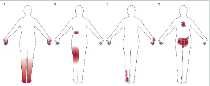 Figure 4 : Les formes d’atteinte nerveuse dans la neuropathie diabétique (19).  