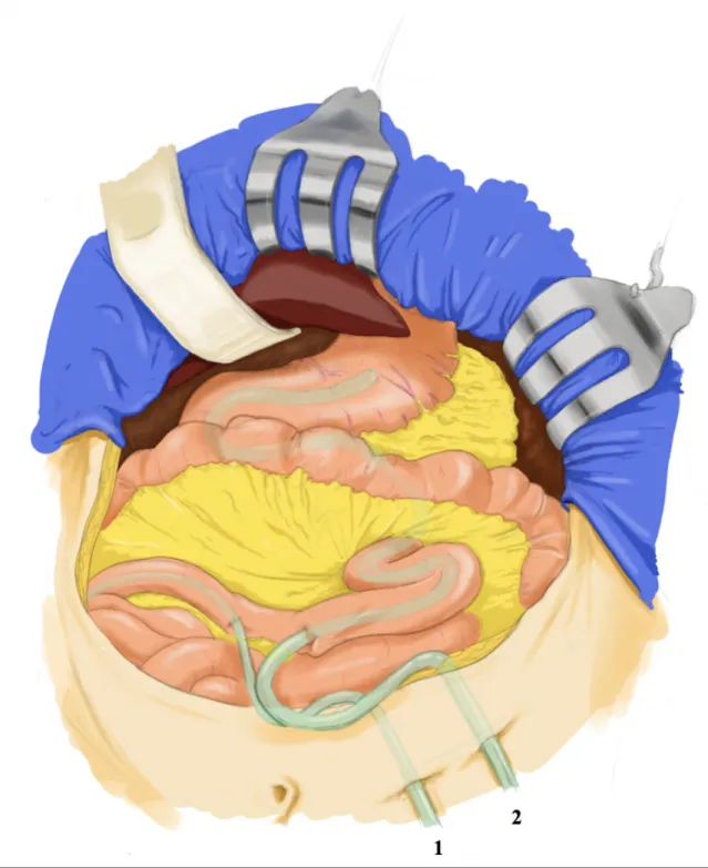 Figure 1. Mise en place d’une jéjunogastrostomie rétrograde  