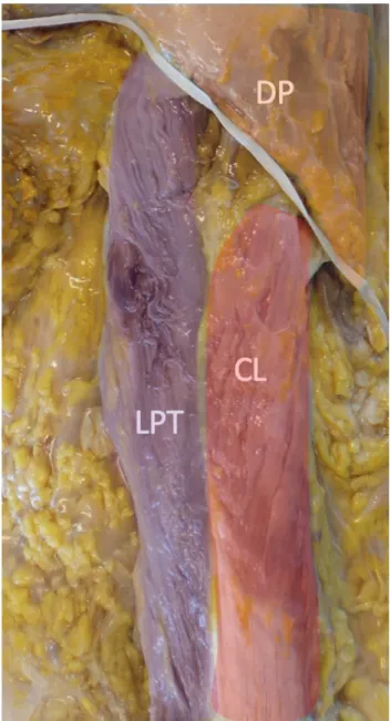 Figure 13 : Vue anatomique postérieure du chef long (LPT) et chef latéral (CL) par rapport au  deltoïde postérieur