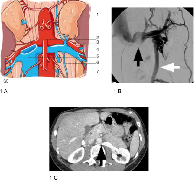 Figure  1 :    A :  Compression  de  la  veine  rénale  gauche  par  la  pince  aorto- aorto-mésentérique,  ou  syndrome  du  casse-noisette :  1-  Aorte ;  2-  artère  mésentérique  supérieure ; 3- veine surrénale ; 4- veine rénale gauche ; 5- veine cave 