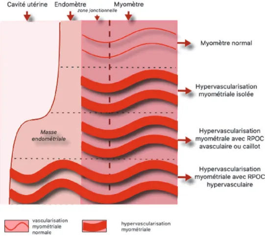Figure 7 : représentation schématique des différentes AVU en comparaison à la  vascularisation myométriale normale