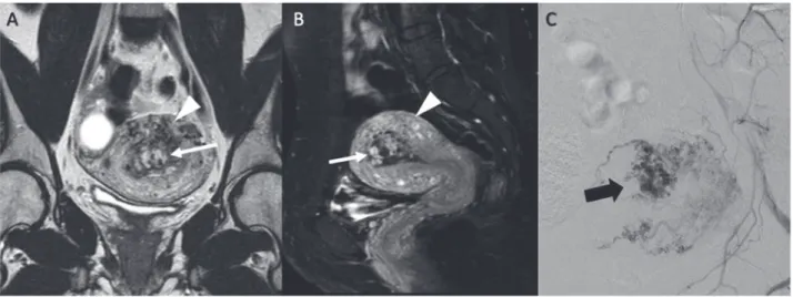 Figure 11 : patiente aux antécédents d’IMG à 14 SA, 3 mois plus tôt. A et B – séquence coronale  en pondération T2 et sagittal en pondération T1 avec saturation de la graisse après injection de  gadolinium montrant une masse hétérogène à cheval sur l’endom