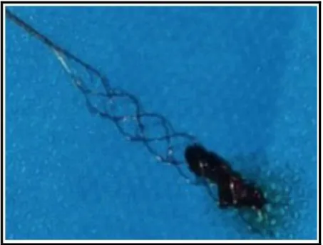 Figure 3: caillot récupéré après TM dans un stent retriever, d’après Boustia F. et al., La presse médicale, 2019