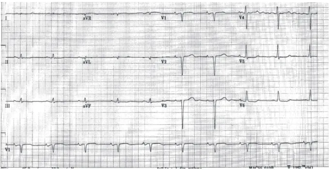 Figure 6 : électrocardiogramme d’un patient âgé de 70 ans porteur d’une amylose cardiaque à transthyrétine  sauvage (épaisseur du septum interventriculaire télédiastolique mesuré en ETT à 20mm)