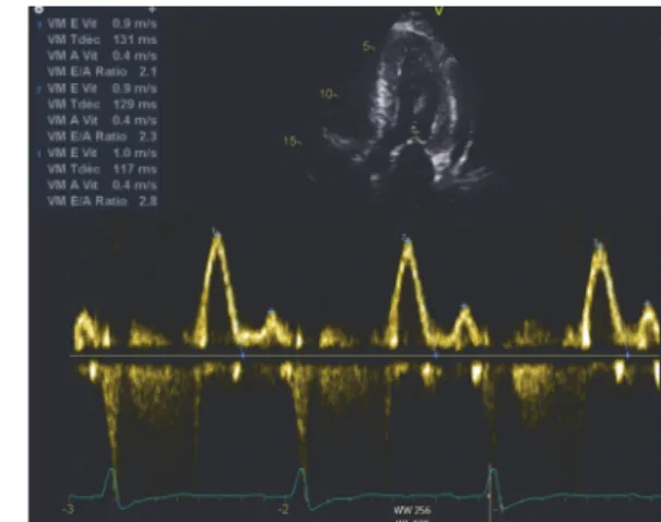 Figure 12 : Images échographiques d’un patient âgé de 76 ans porteur d’une amylose cardiaque à  transthyrétine sauvage (hypertrophie myocardique, épanchement péricardique, profil restrictif)