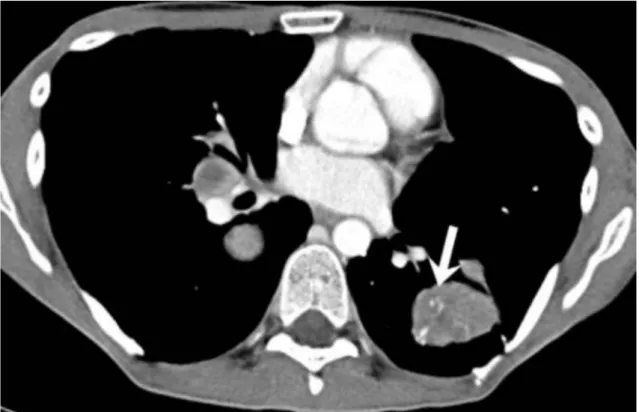 Figure  6.  Scanner  thoracique  injecté  au  temps  portal  d’un  patient  atteint  de  SAPM  métastatique  au  niveau  pulmonaire