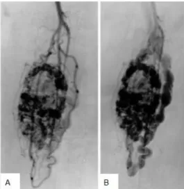 Figure  9.  Angiographie  d’un  SAPM  du  triceps  sural  (découvert  chez  une  femme  de  39  ayant  présenté  des  douleurs  du  genou  dans  un  contexte  de  maladie  d’emblée  métastatique  au  niveau  osseux)