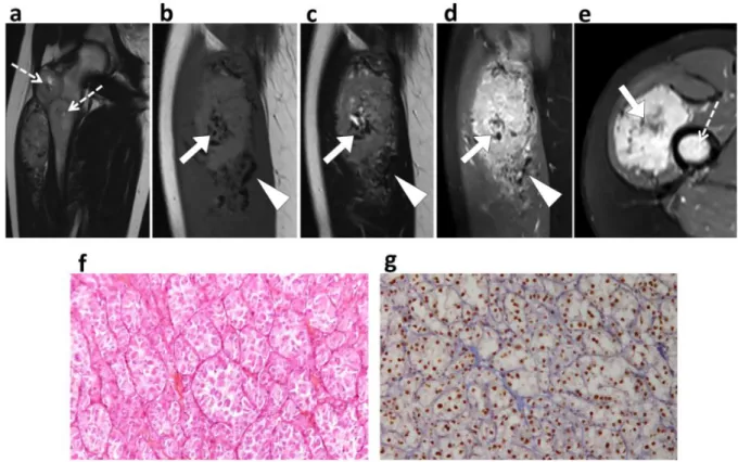 Figure 1.  Typical alveolar soft-part sarcoma – Radio-pathological correlation. (a) Coronal T2-weighted imaging  demonstrated a deep-seated tumor within the right quadriceps femoris with synchronous femoral bone 