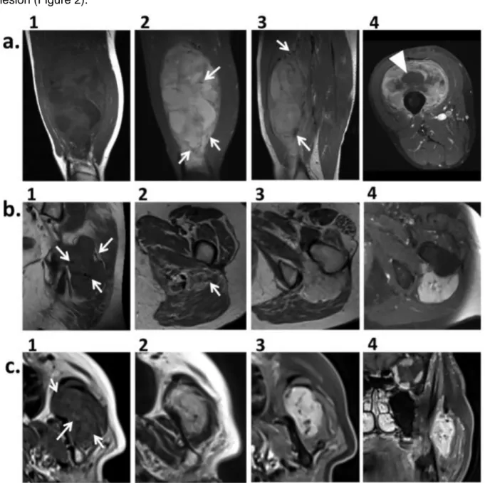 Figure 2. Soft-tissue tumors sharing the MRI features associated with alveolar soft-part sarcoma