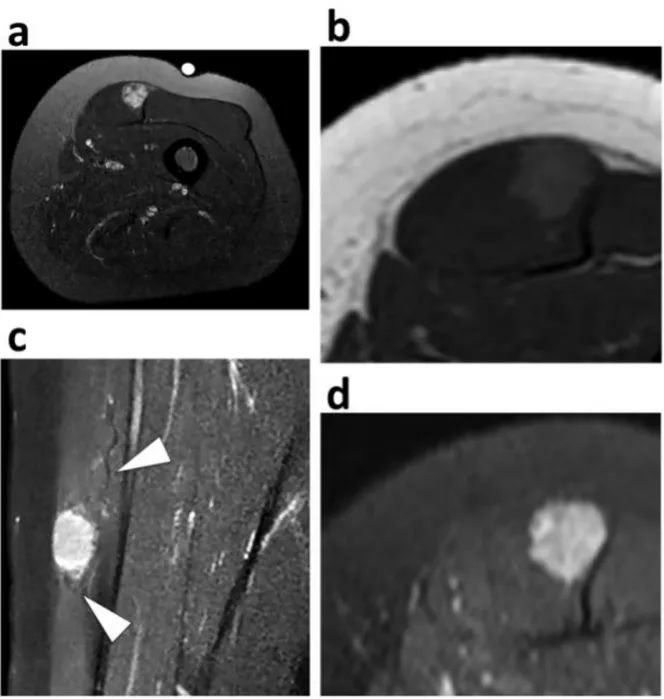 Figure 3.  Small alveolar soft-part sarcoma. (a) Axial STIR T2-weighted imaging showed a 2cm large deep- deep-seated tumor of the right quadriceps femori with heterogeneous high Signal intensity on T2-weighted imaging