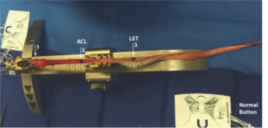 Figure  3  :  Exemple  de  greffon  du  groupe  DT4  +  LAL  et  schéma  de  représentation  de  la  technique chirurgicale 