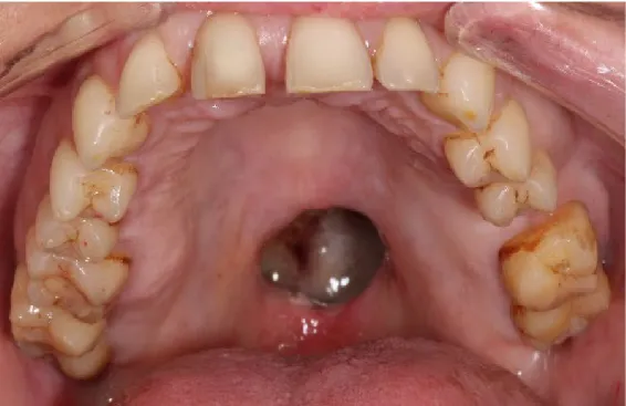 Figure 6 : Perforation palatine cas 2  