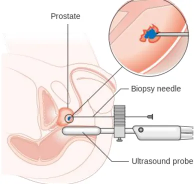 Figure 3  : biopsie trans périnéale .  