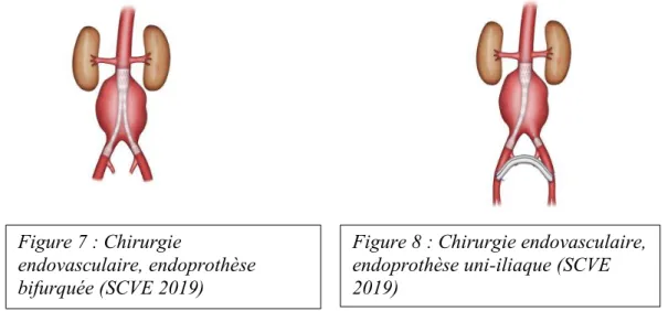 Figure 8 : Chirurgie endovasculaire,  endoprothèse uni-iliaque (SCVE  2019) 