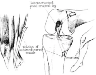 Figure 9.  MACEY,  H.B (1939) : A new operative  procedure  for repair of ruptured  cruciate  ligament of the knee joint