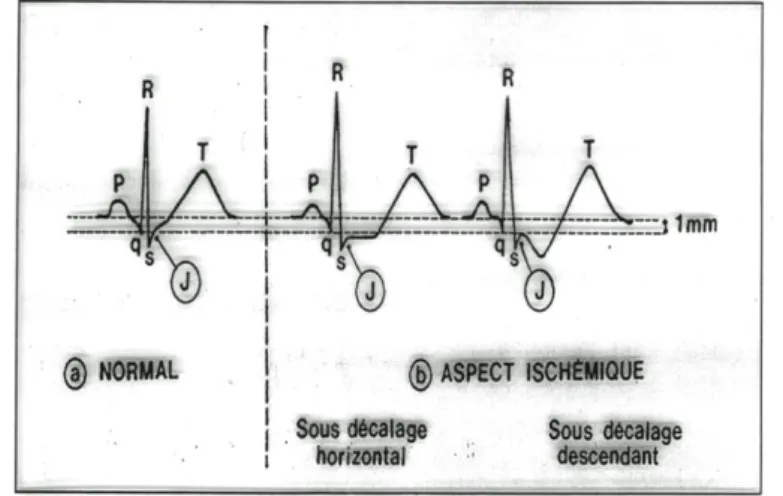 FIGURE 6 : Modifications de l’ECG à l’effort  a.  Aspect normal : segment PQ descendant et segment ST ascendant 