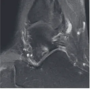 Figure 4 :Arthrose postérieure sous talienne  (patient7)  
