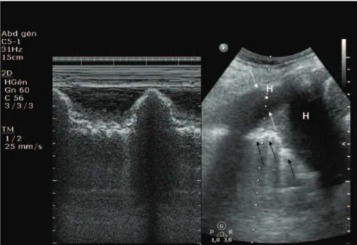 Figure  2.  Typical  image  of  hemothorax  and  lung  contusion  in  M-mode  (left)  and  conventional two-dimensional (right) imaging