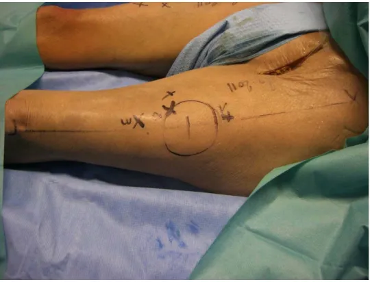 Figure  4:  each  perforator  was  located  by  coordinates  (x,y),  x  corresponding  to  the  thigh   anatomic axis and y to its perpendicular