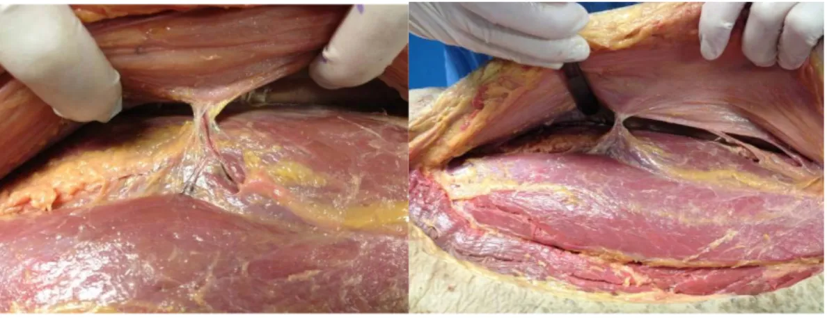 Figure  6:  cadaveric  dissection.  The  dissection  was  performed  under  the  fascia  to  find  perforators the projection of which was then marked on the skin by a cross