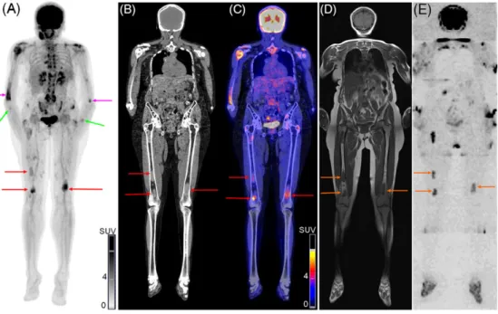 FIGURE 5 Images of whole ‐ body (WB) combined [ 18 F]NaF/[ 18 F]FDG PET/CT (A: PET: maximum intensity projection; B: CT; C: fused PET/CT) and MRI (D: T1 ‐ weighted spin ‐ echo images; E: DWI) of a 55 ‐ y ‐ old female patient with relapsed multiple myeloma 