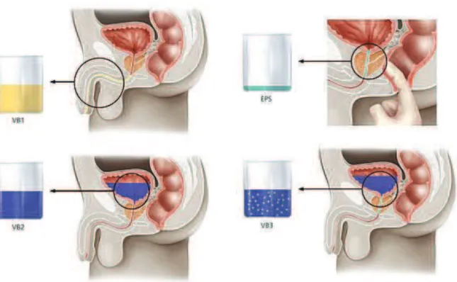 Figure 1. Lépreuve de Meares et Stamey 4-glass test (EPS = expressed prostatic secretions; 