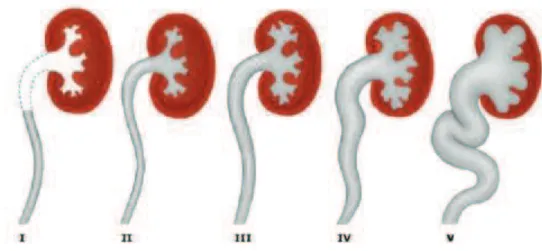 Figure 1 : Classification des RVU selon la classification internationale de 1985 (9)