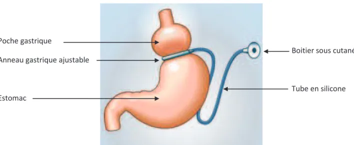 Fig. 6 : anneau gastrique ajustable (AG)[16] 