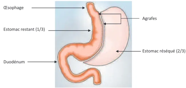 Fig. 7 : la gastrectomie longitudinale ou sleeve gastrectomy(GL) [16] 
