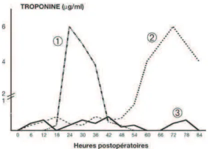 Figure 1 : cinétiques de troponine Ic dans 3 types de DMPO : 1) DMPO précoce, 2) DMPO retardé, faisant suite à des nécroses  myocardiques à minima mais répétées, 3) DMPO à minima sans évolution vers linfarctus massif daprès Coriat et al