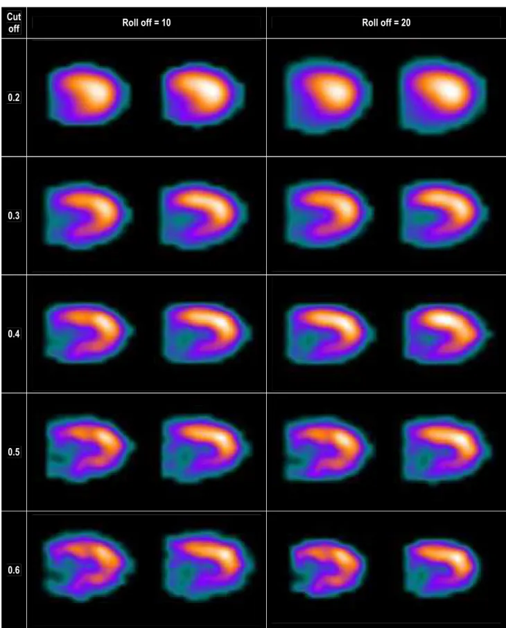 Figure 5 : Effet de différents filtres Butterworth sur l’aspect d’une TSM de perfusion au  201 Thallium de stress chez un même  patient 