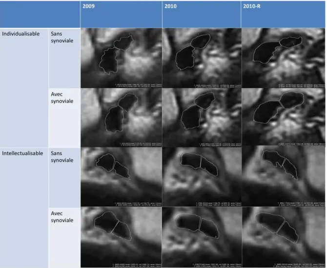 Figure  n° 7 : exemples de morphotypes ligamentaires chez  deux patients, après détourage  sur la  coupe de mi-longueur à grossissement de 400% des faisceaux, avec ou sans prise en compte de la  synoviale en 2009, 2010 et 2010 en recalage d’images