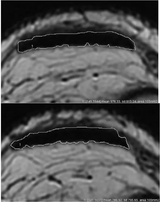 Figure n° 8 : détourage des tendons rotuliens chez un même patient sur une coupe axiale, en 2009 (en haut),  et en 2010 (en bas)