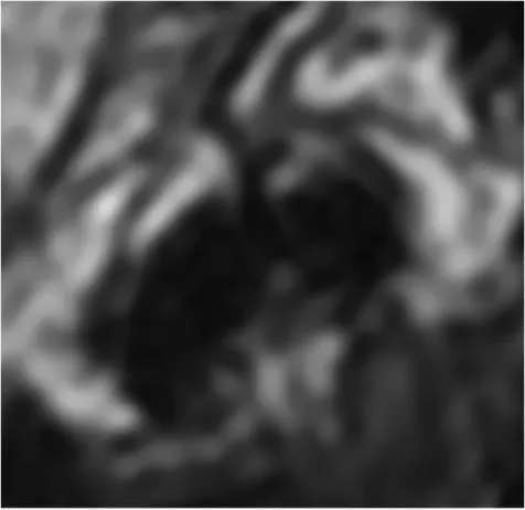 Figure n°9 : vaisseau en hyposignal identique au collagène venant s’immiscer entre les deux  faisceaux