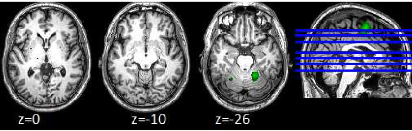 Figure  5.  Comparison  of  ALE  maxima  between  stroke  patients  and  healthy  subjects  for  impaired/ right hand mouvements