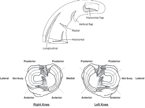 Figure 1: Classification des lésions méniscales selon ISAKOS 2006 (16) 