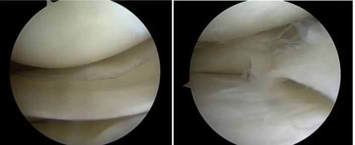 Figure 7: Vue sous arthroscopie d'une lésion longitudinale avant et après réparation  par le système all-inside FastFix 