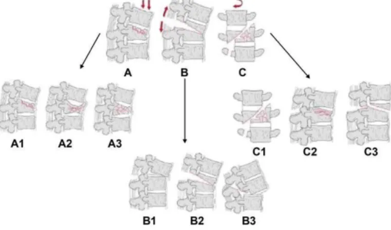 FIGURE 13. Classification de l’AO  modifié par Vaccaro 