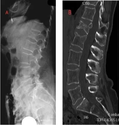 FIGURE 17. Mesure de la cyphose  vertébrale et régionale 