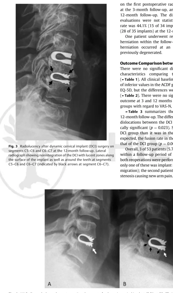 Fig. 4 (A) Radiograph shows the postoperative placement of a dynamic cervical implant (DCI) at C6–C7