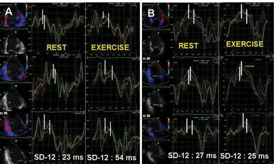 Figure 3 Tissue Doppler imaging echocardiograms depicting exercise-induced changes in systolic dyssynchrony index being estimated as the standard deviation of the time-to-peak systolic velocities of the 12 LV segments (SD-12)