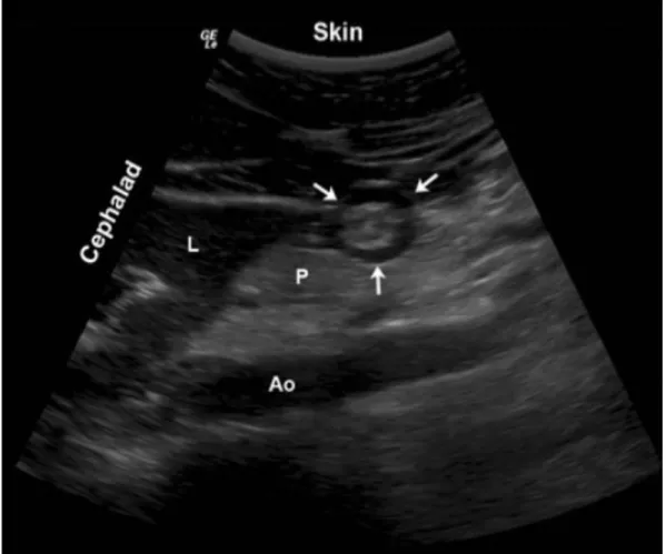 Figure 6 : Antre d’un estomac vide en coupe sagittale (27).  