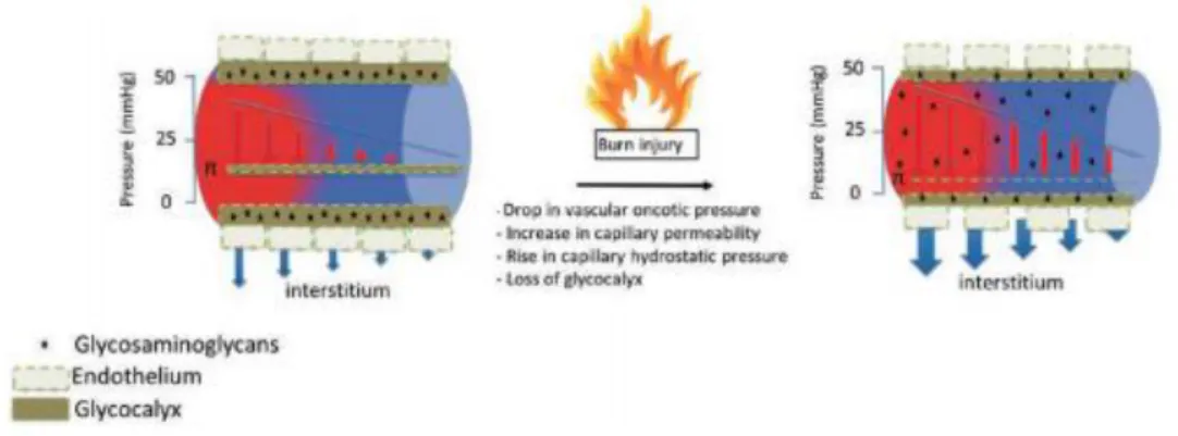 Figure  2 : Physiopathologie  du  syndrome  de  fuite  capillaire  chez  des  patients  atteints  de  brulure