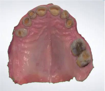 Figure 10 : Empreinte numérique de l’arcade maxillaire 