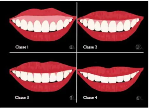 Figure 3 : Classification de la ligne du sourire par Liébart 