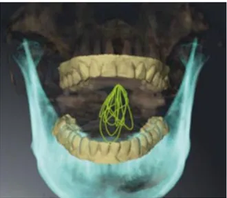 Figure 9 : Fusion des données de la JMA avec les images CBCT où sont placés les modèles numériques 