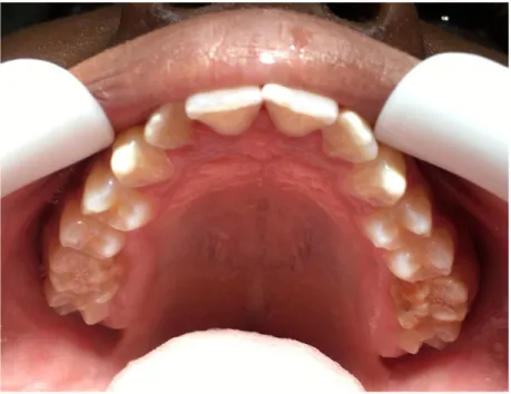 Figure 3 : Vue occlusale de l’arcade maxillaire 