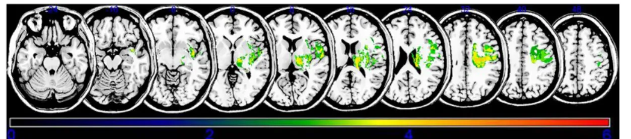 Figure 5 :  Résultats des lésions cérébrales identifiées par VLSM entrainant de la spasticité au niveau des  membres supérieurs