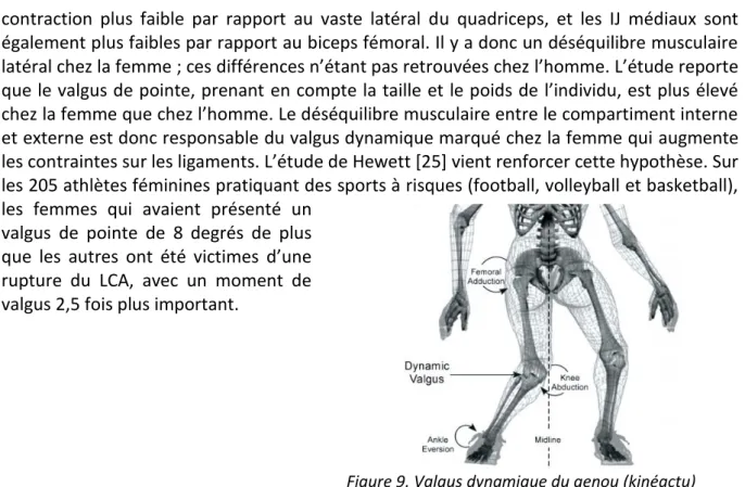 Figure 9. Valgus dynamique du genou (kinéactu) L’étude de l’angulation du valgus dynamique, associée à une analyse de la force musculaire  du quadriceps et des IJ, serait un très bon élément prédictif du risque de rupture du LCA